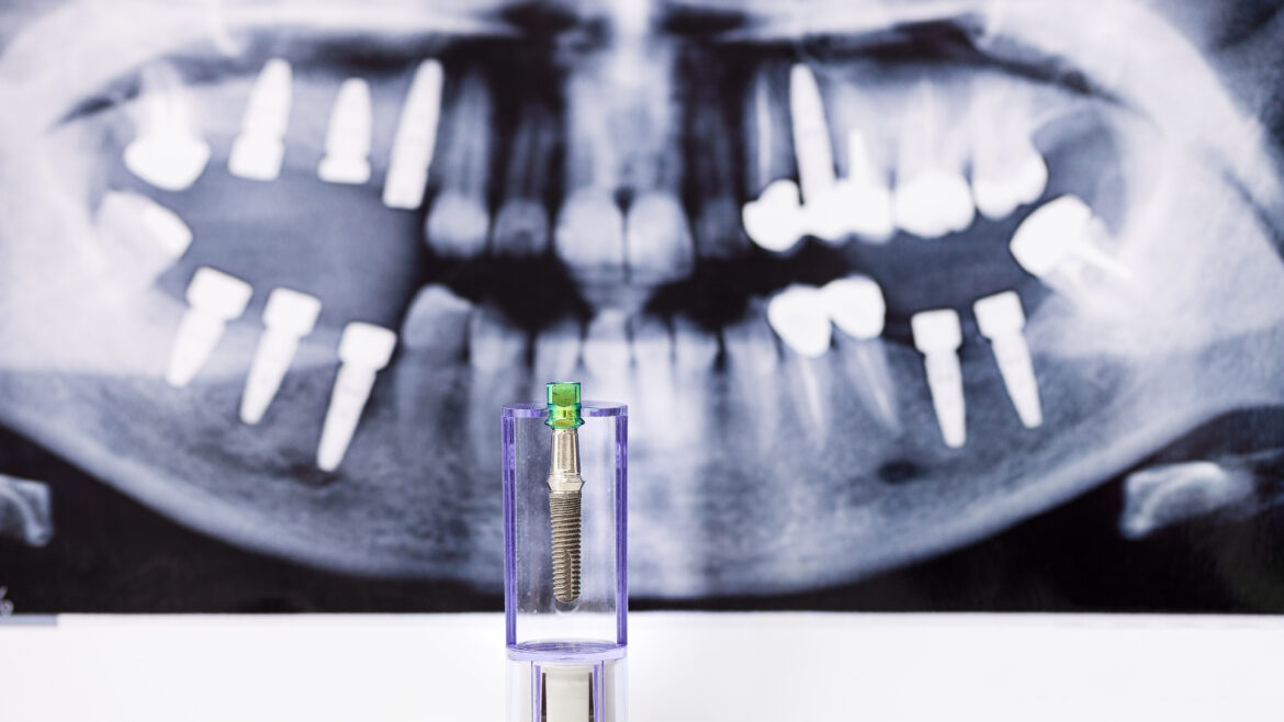 Dental Implants